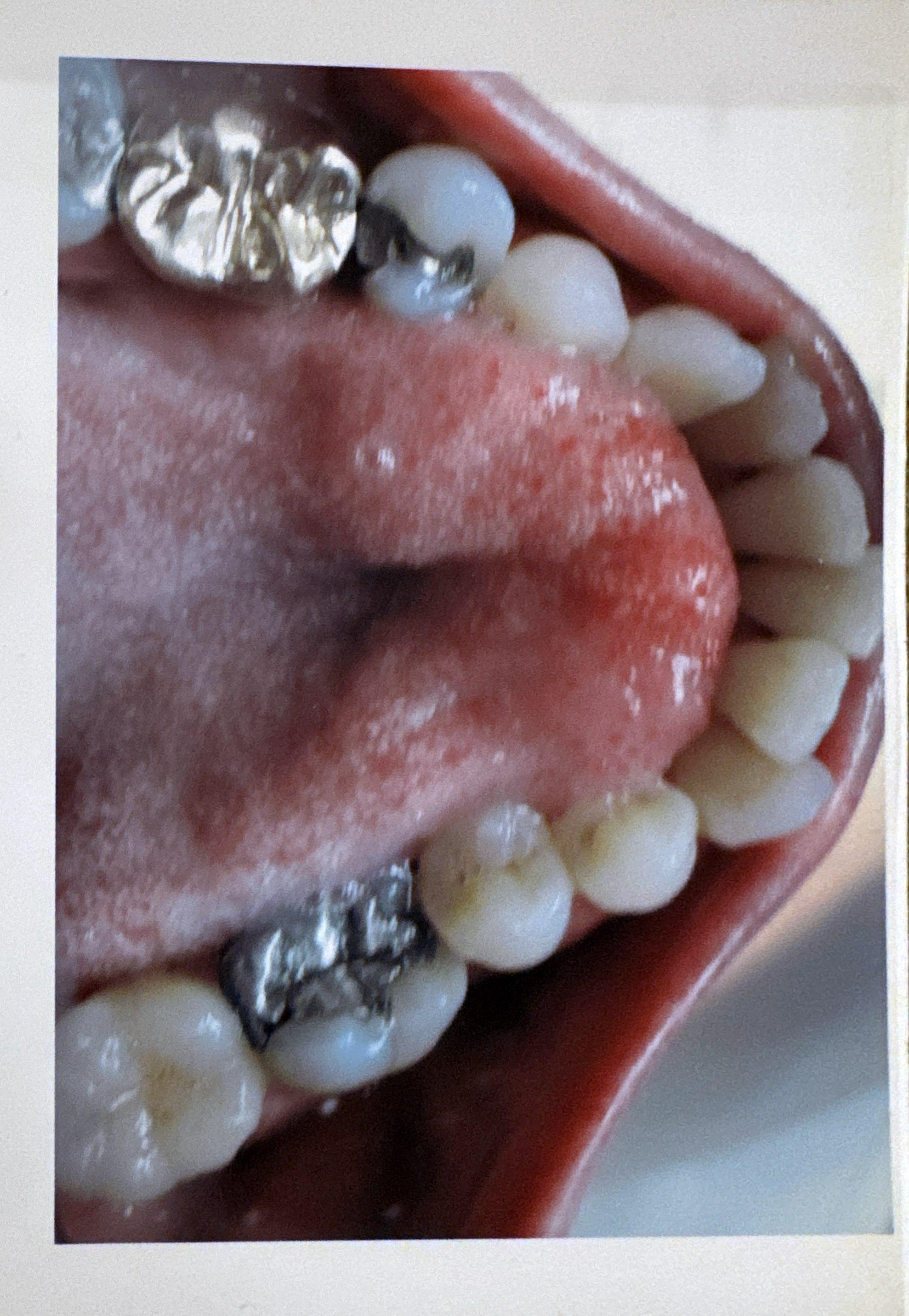 Smile before Invisalign treatment